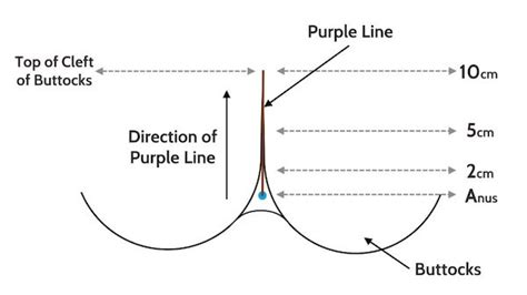 purple line dilation on dark skin|purple line on butt pregnancy.